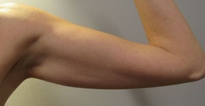 BodyTite, Arms before and after photo by Hughes Plastic Surgery in Los Angeles, CA