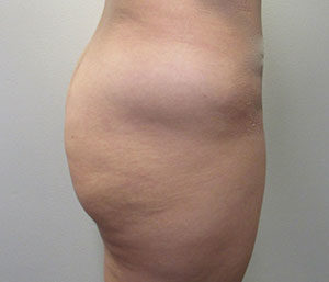 Butt Implants Case 9446 Before Photo