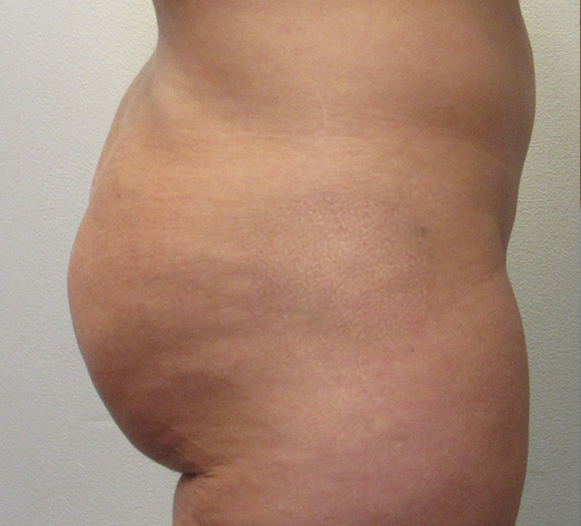 Liposuction Revision and Cellulite Reduction before and after photos by Hughes Plastic Surgery in Los Angeles, CA