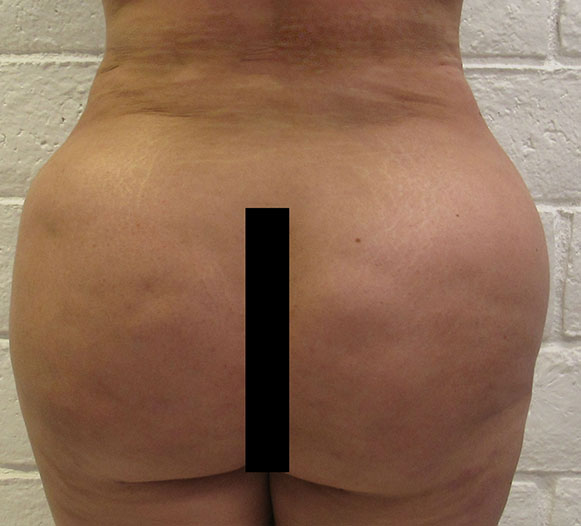 Liposuction Revision and Cellulite Reduction before and after photos by Hughes Plastic Surgery in Los Angeles, CA