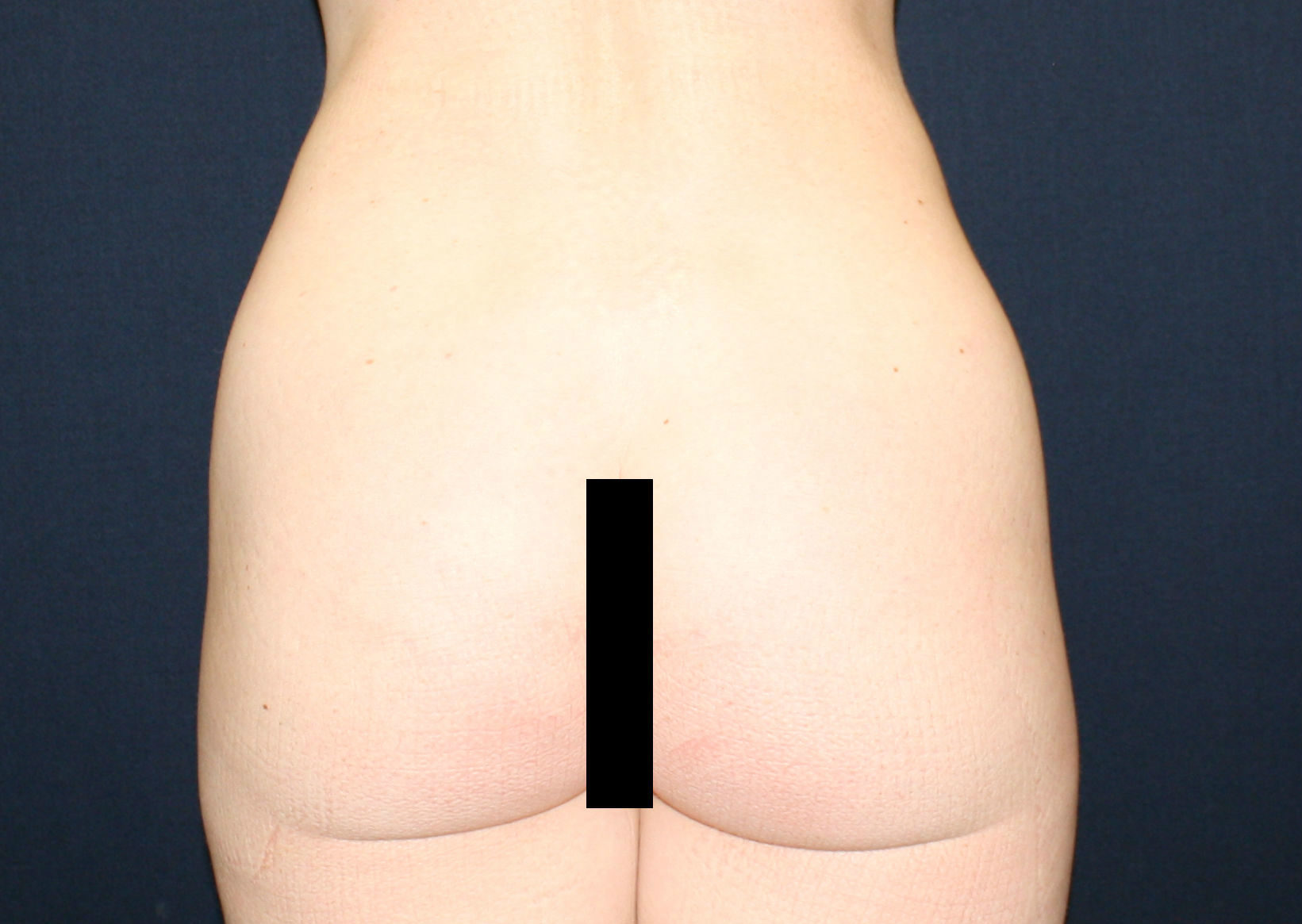 Butt Implants Case 9551 Before Photo