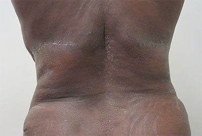 Body Lift before and after photos by Hughes Plastic Surgery in Los Angeles, CA