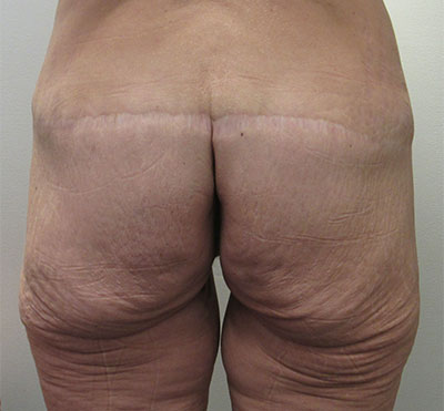 Body Lift before and after photos by Hughes Plastic Surgery in Los Angeles, CA