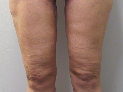 Thigh Lift before and after photos by Hughes Plastic Surgery in Los Angeles, CA