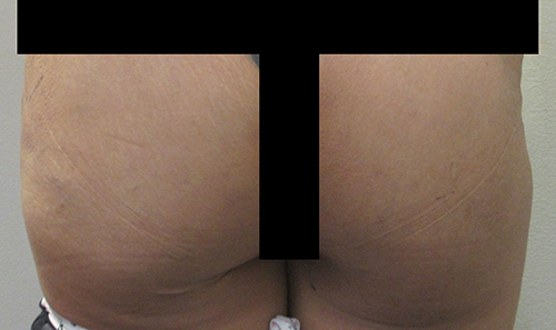 Silicone Injections & Biopolymer Removal before and after photo by Hughes Plastic Surgery in Los Angeles, CA