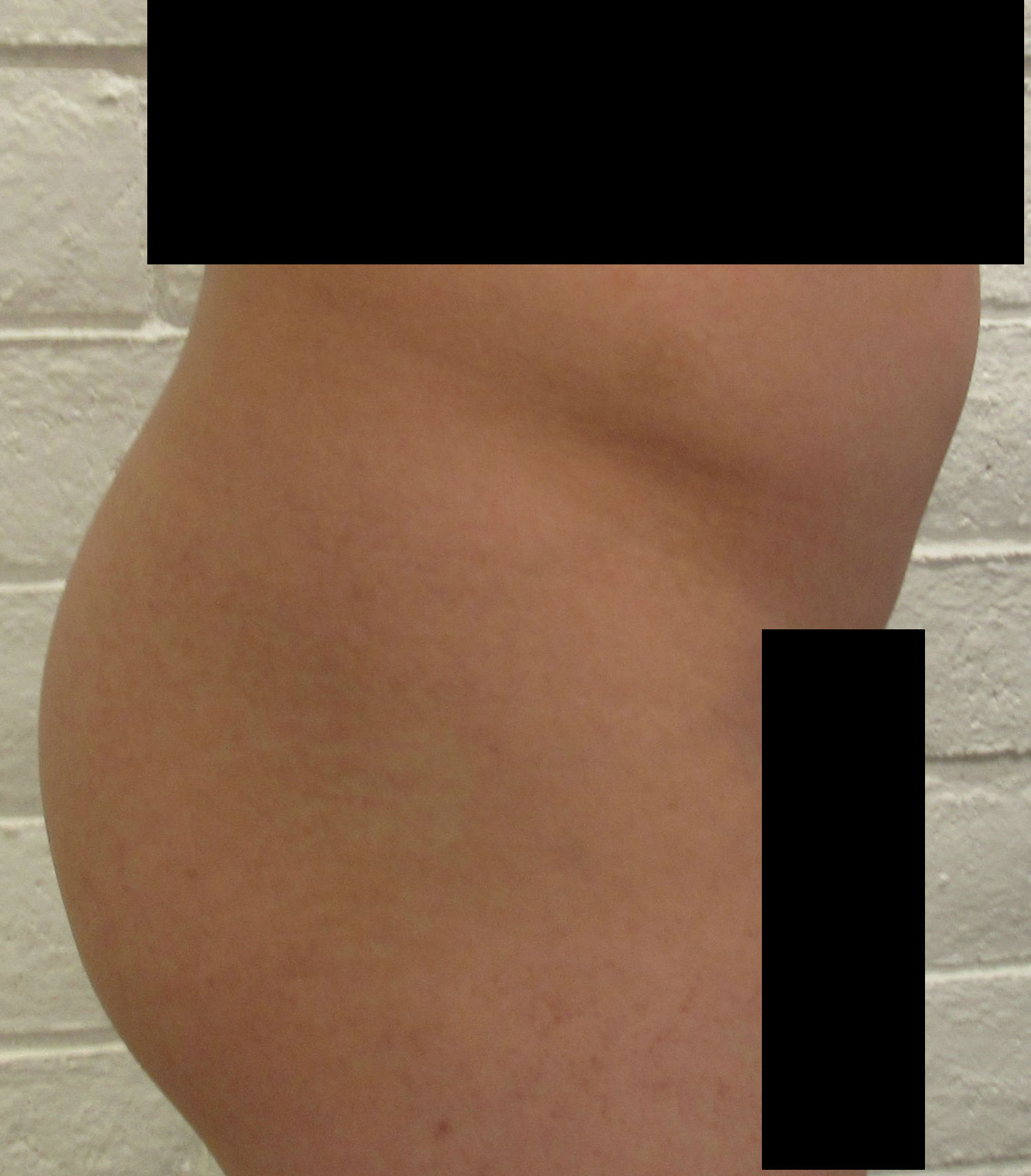 Butt Implants Case 10009 Before Photo