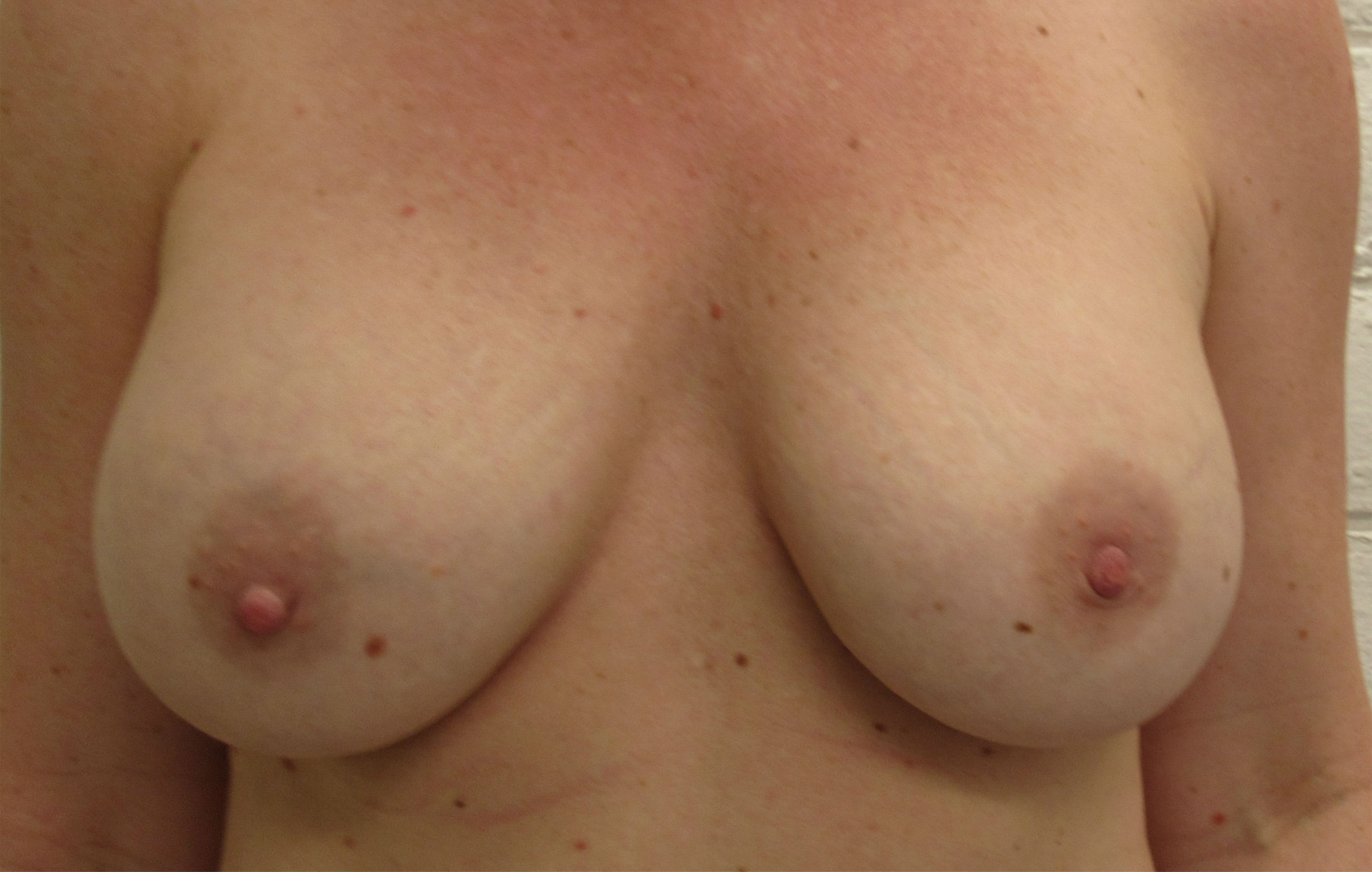 Breast Augmentation with Fat Grafting before and after photos by Hughes Plastic Surgery in Los Angeles, CA