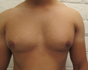 Male Gynecomastia before and after photos by Hughes Plastic Surgery in Los Angeles, CA