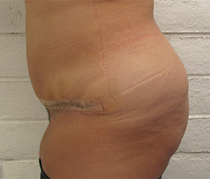 Tummy Tuck before and after photo by Hughes Plastic Surgery in Los Angeles, CA