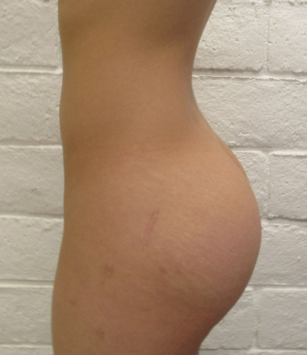 Butt Implants Case 10295 Before Photo