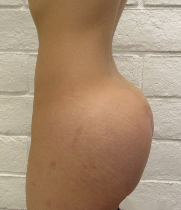 Butt Implants Case 10295 After Photo