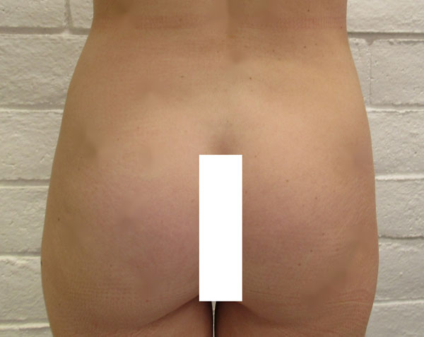 Butt Implants Case 10292 Before Photo