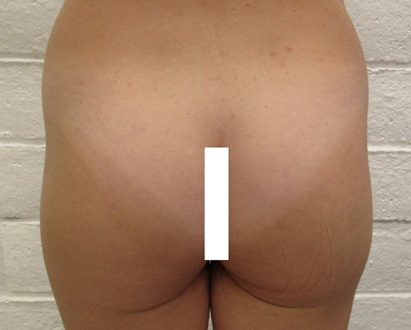 Butt Implants Case 10298 Before Photo