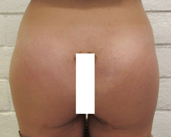 Butt Implants Case 10298 After Photo
