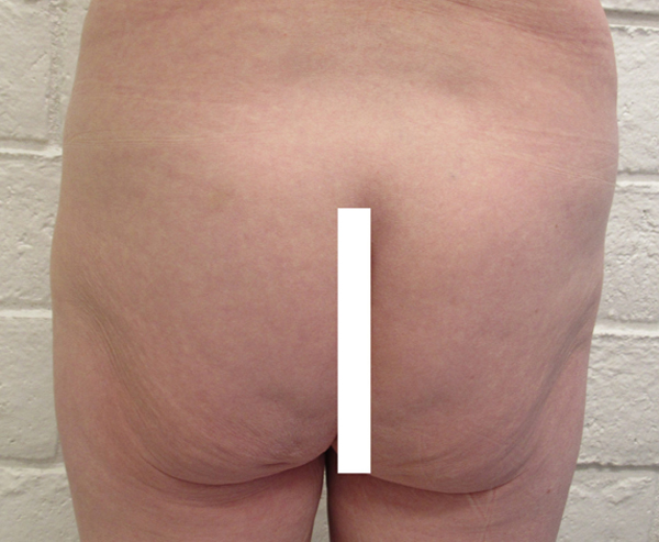 Butt Implants Case 10195 Before Photo
