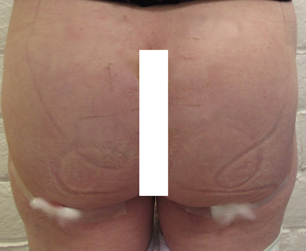 Butt Implants Case 10195 after Photo