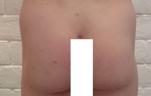 Butt Implants Case 10201 Before Photo