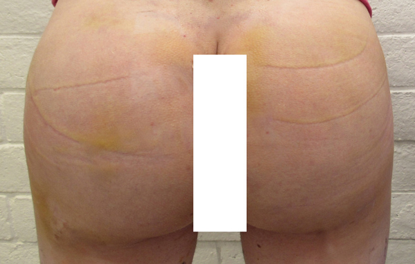 Butt Implants Case 10201 After Photo