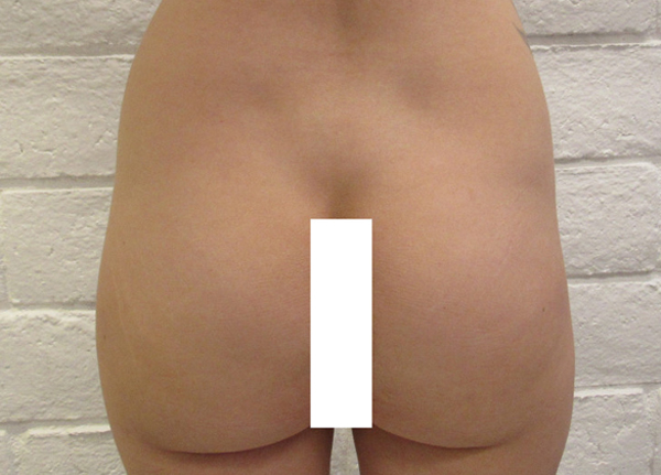 Butt Implants Case 10202 Before Photo