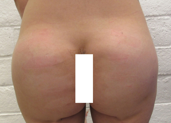 Butt Implants Case 10202 After Photo