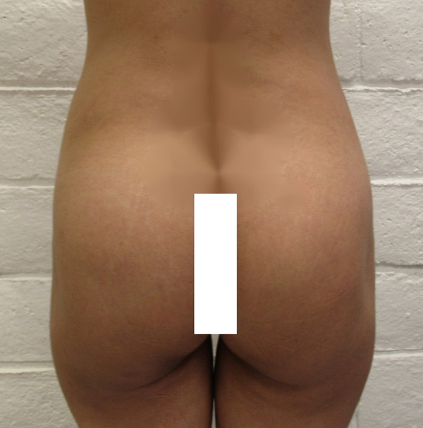 Butt Implants Case 10203 Before Photo
