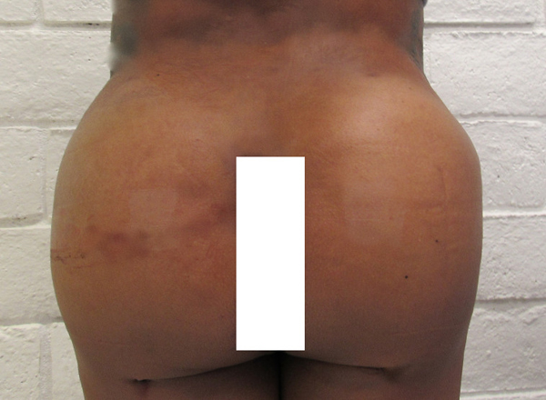 Butt Implants Case 10205 After Photo