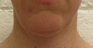 Facelift, FaceTite before and after photo by Hughes Plastic Surgery in Los Angeles, CA
