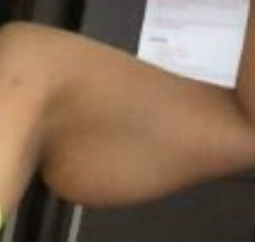 Liposuction, Arms before and after photo by Hughes Plastic Surgery in Los Angeles, CA