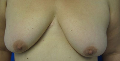 Breast Lift before and after photos by Hughes Plastic Surgery in Los Angeles, CA