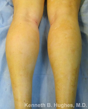 Calf Augmentation with Fat Grafting and Implants Results Los Angeles