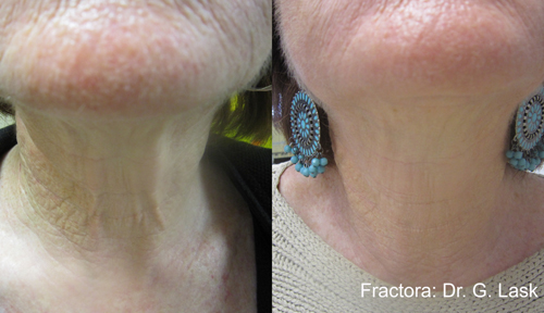 Fractora Before & After
