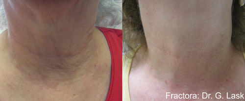 Fractora Before & After