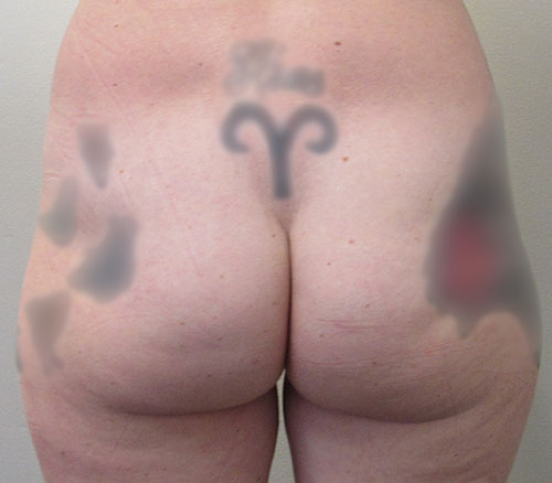 Silicone Injections and Biopolymer Removal from Buttocks Los Angeles