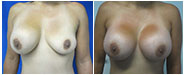 Breast Augmentation Revision Before & After
