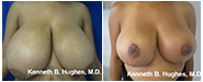 Breast Lift Before & After