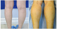 Calf Augmentation & Implants Before & After