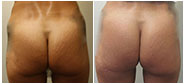 Liposuction Revision and Cellulite Reduction Before & After