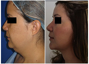 Chin Liposuction Before & After