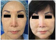 Face & Neck Lift Before & After