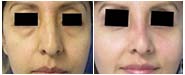 Facial Fat Grafting Before & After