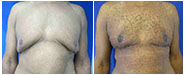 Gynecomastia, Male Breast Reduction Los Angeles Beverly Hills Before & After Photos