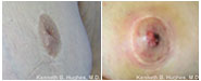 Inverted Nipple Correction Before & After