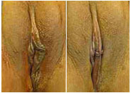Labial Rejuvenation - Labiaplasty Before & After