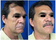 Male Neck Lift Before & After