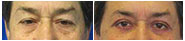 Male Eyelid Surgery Before & After