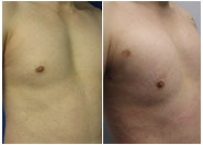 Pectoral Implants Before & After