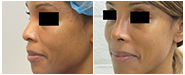 Rhinoplasty Before & After Galleries of Dr. Kenneth Hughes