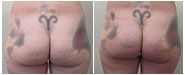 Silicone Injections and Biopolymer Removal from Buttocks Before & After
