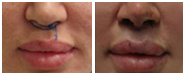 Lip Lift Before & After