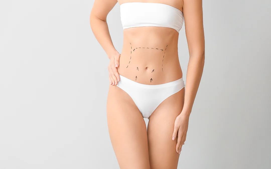 What Should You Expect From A Mini Abdominoplasty or Mini Tummy Tuck?
